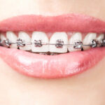 The Role of Braces in Enhancing Social Interactions