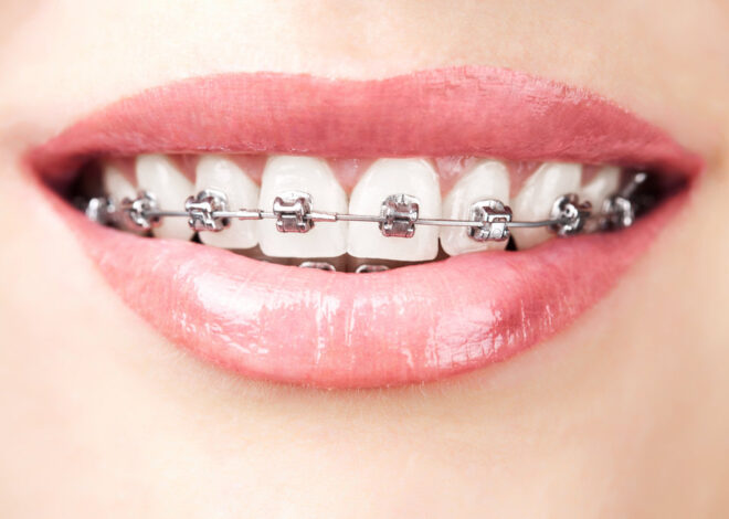 The Role of Braces in Enhancing Social Interactions