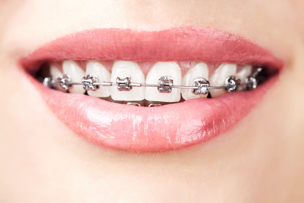 The Role of Braces in Enhancing Social Interactions