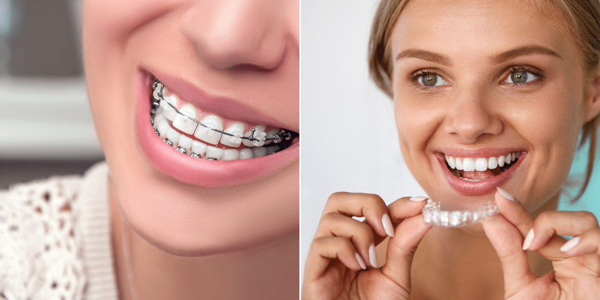 Traditional Braces